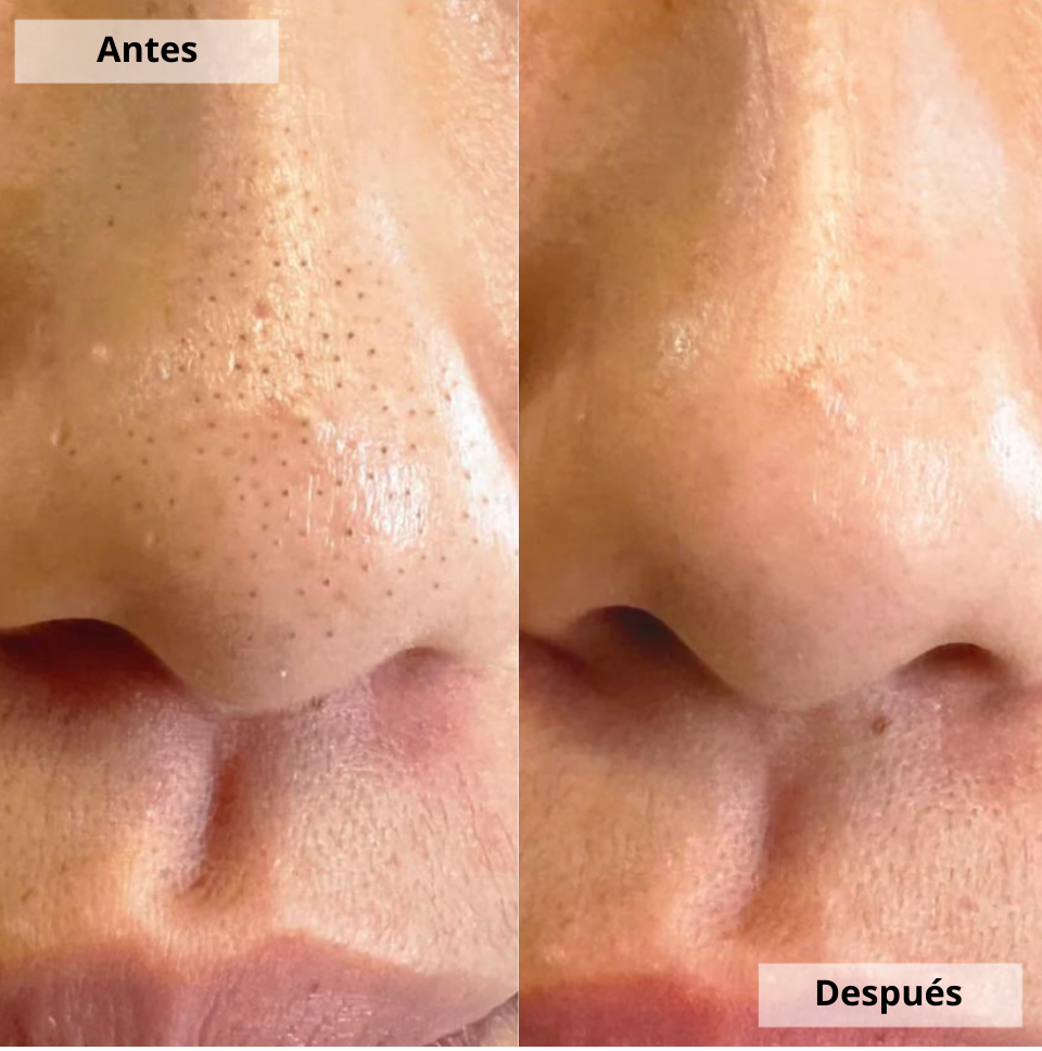 Limpiador de poros Zalery®